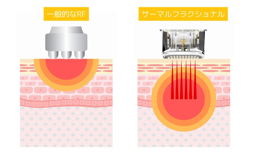 ベルクサーマ照射深度