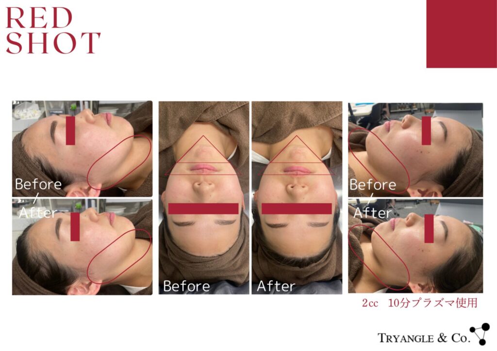 レッドショット症例