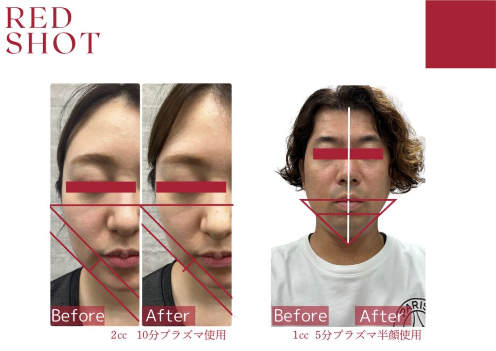 レッドショット症例