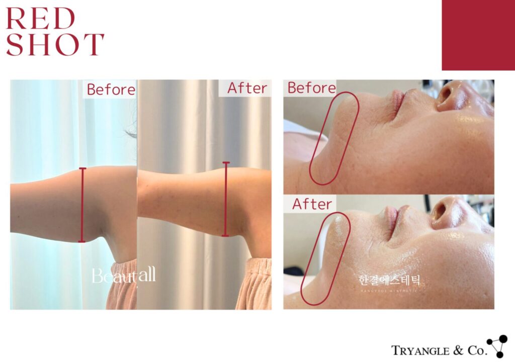 レッドショット症例