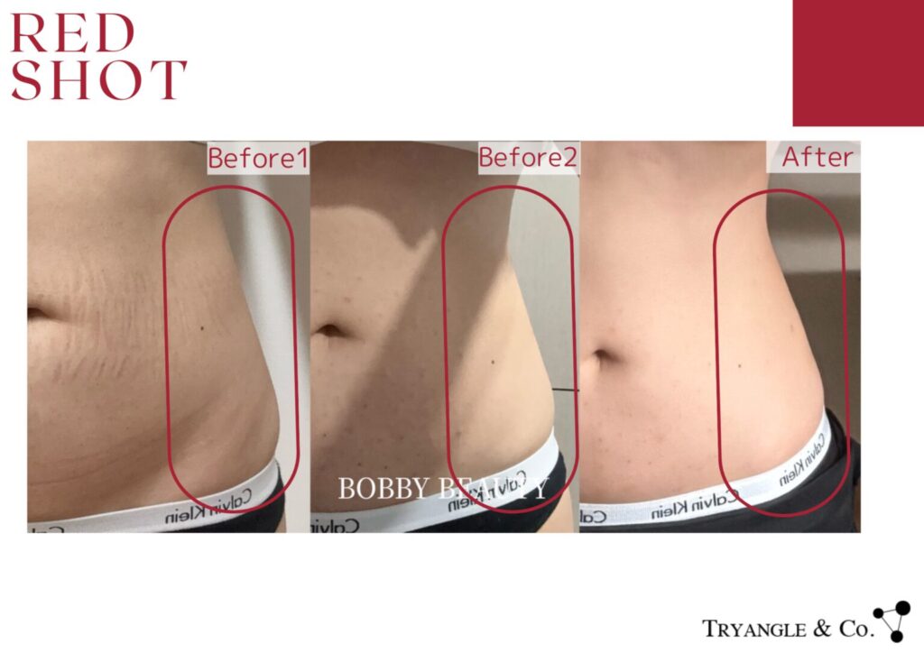 レッドショット症例