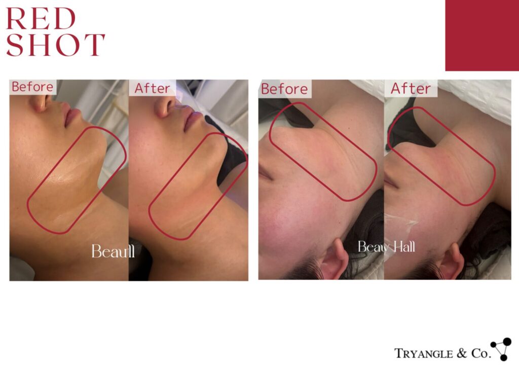 レッドショット症例